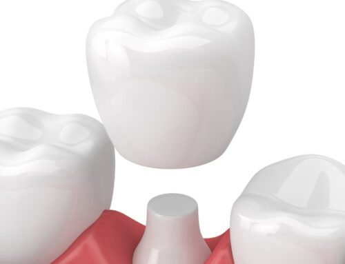What You Need to Know About a Dental Crown