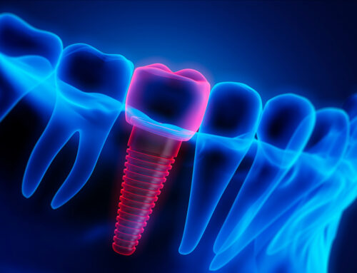 How Can Dental Implants Restore Your Natural Smile